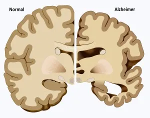 Alzheimer : la régulation du peptide Aβ dans le cerveau malade