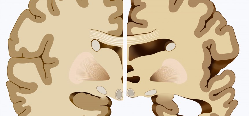 Alzheimer : la régulation du peptide Aβ dans le cerveau malade